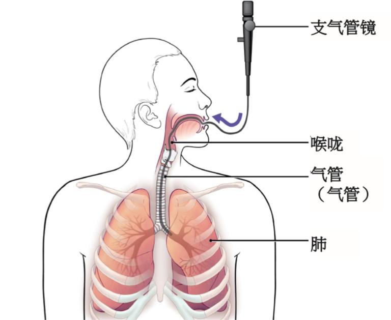 电子支气管镜卓越品质：为呼吸健康保驾护航