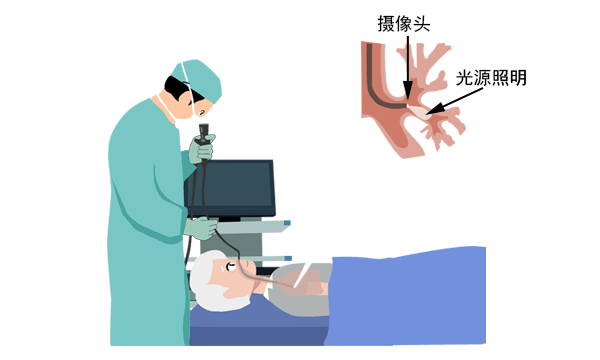 电子支气管镜可以应用在临床哪些科室呢.png